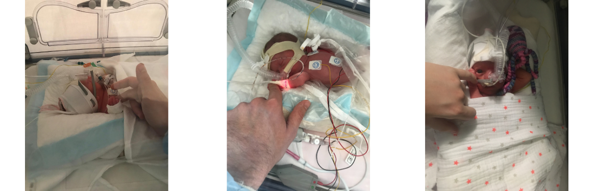 photos-triplés-prematurité